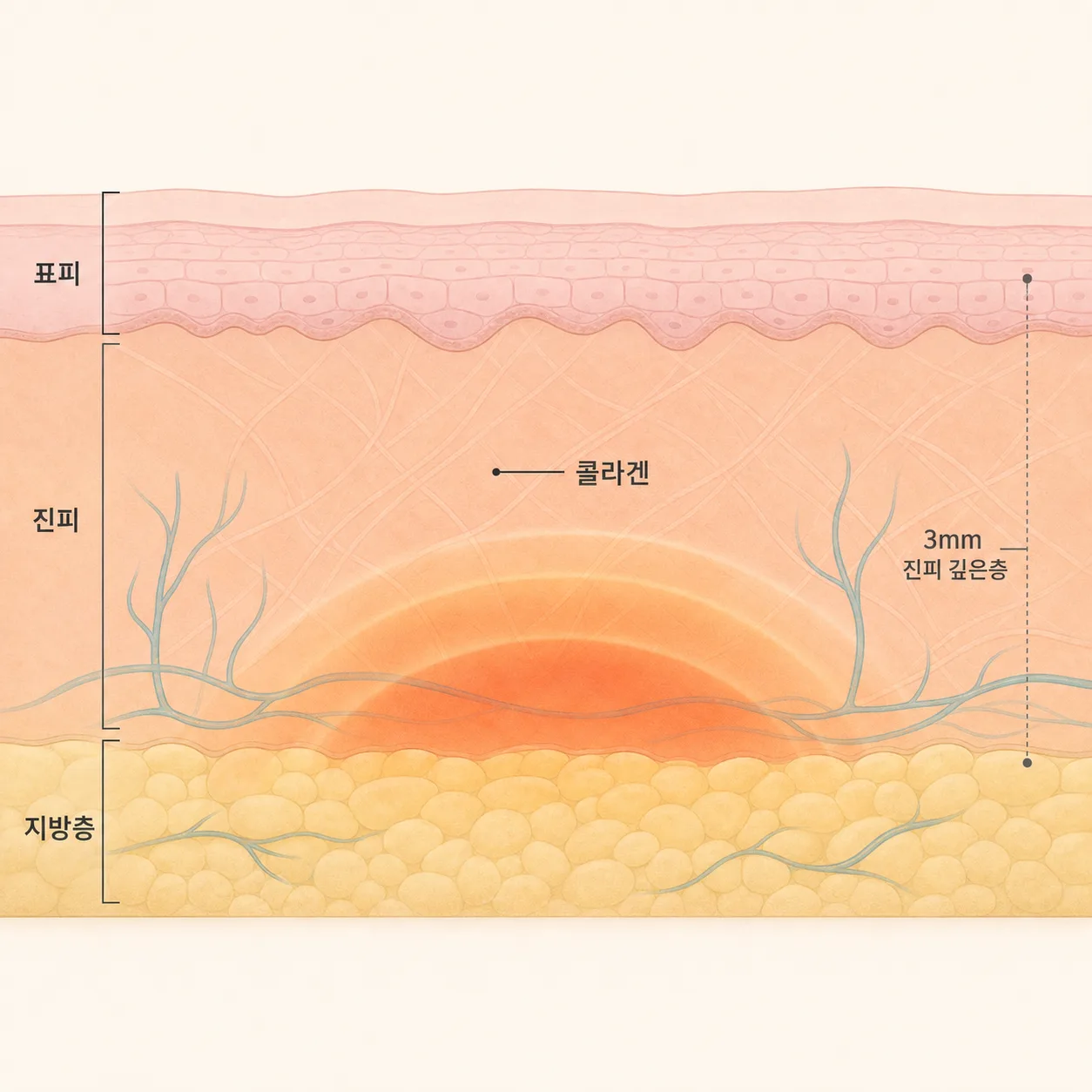 피부 아래층에 전달된 열과 콜라겐 자극 구조
