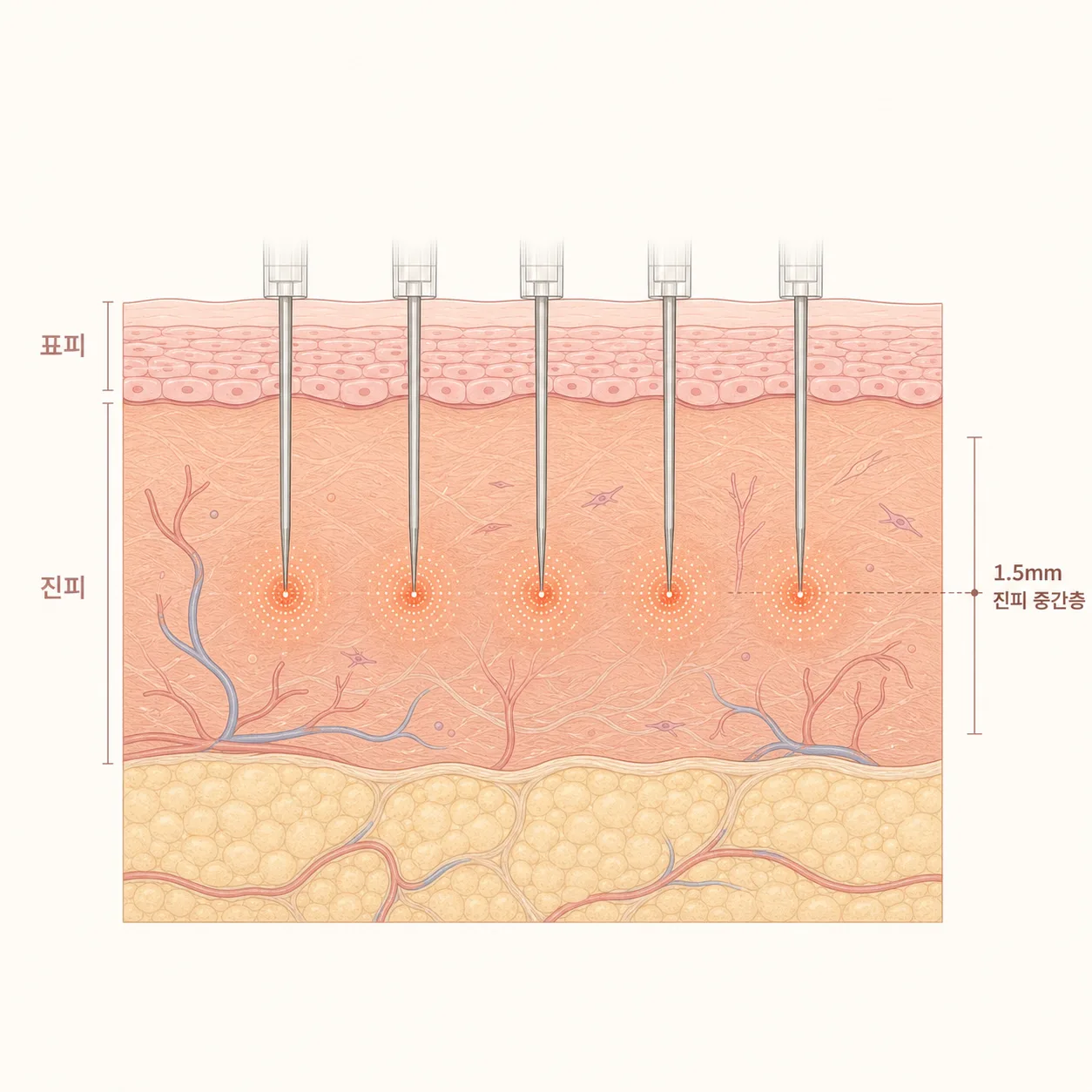 บริเวณความร้อน RF ที่แผ่ออกจากปลายเข็มในชั้นหนังแท้