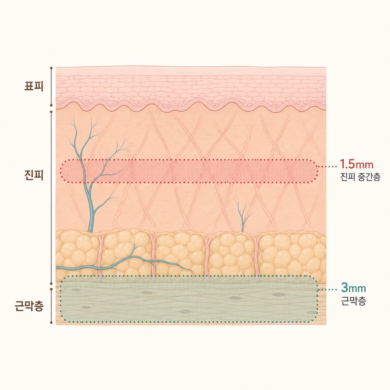 진피 중간층과 깊은 근막층, 서로 다른 초음파 깊이