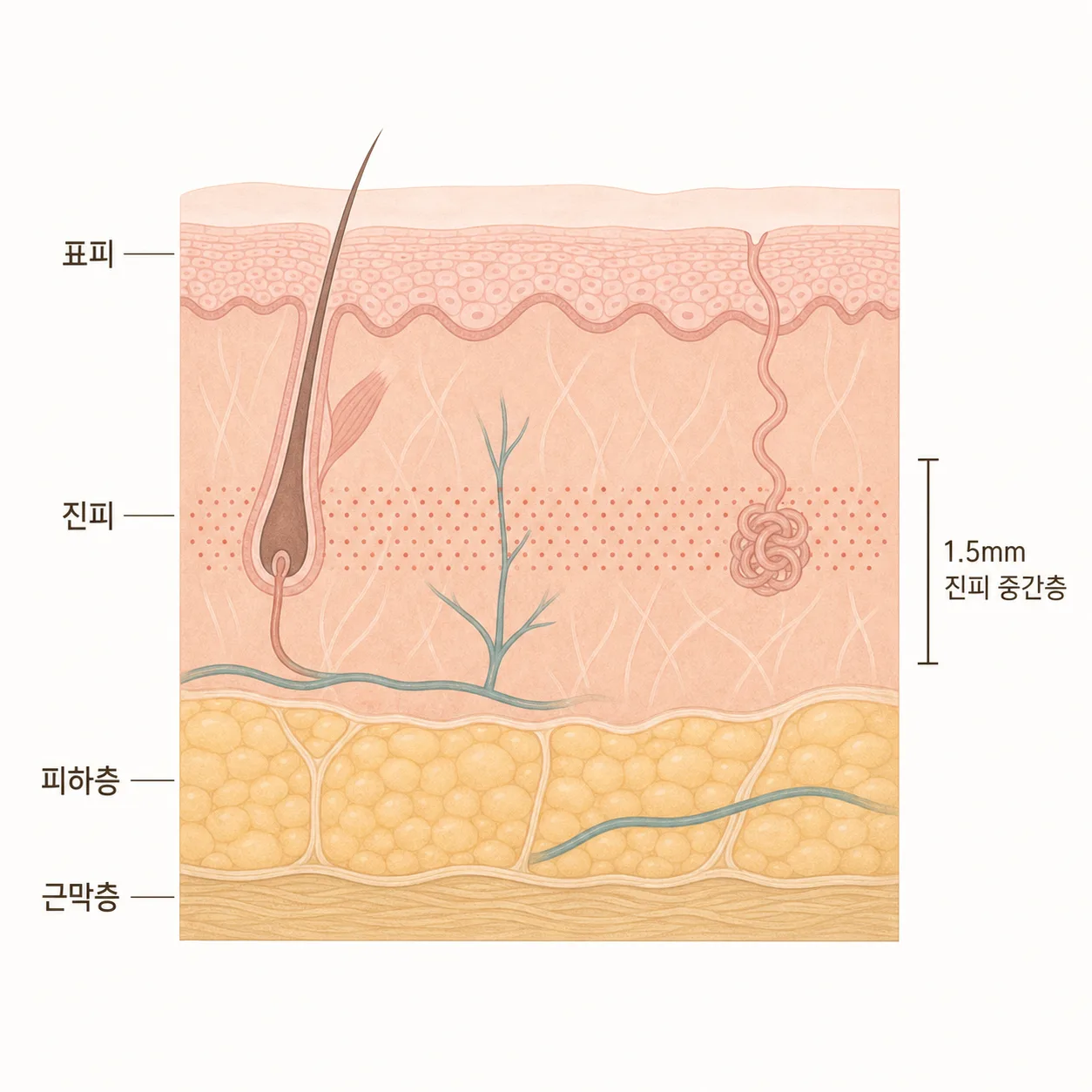 평행 초음파가 진피 중간층에 열을 모으는 깊이