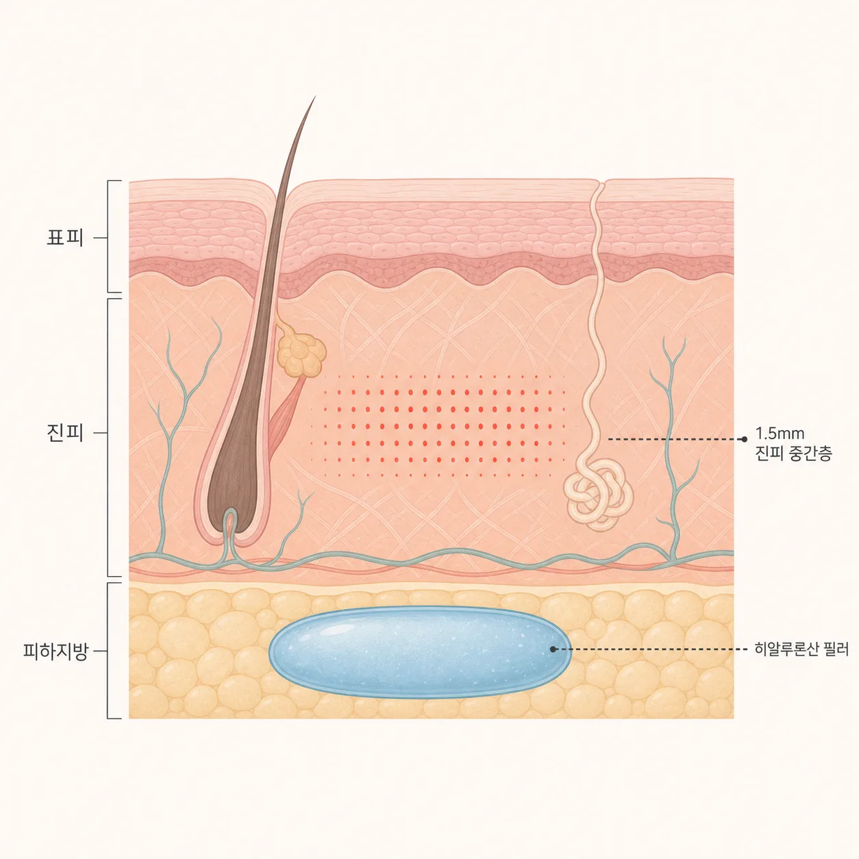 진피층의 고주파 열과 깊은 층의 필러 볼륨