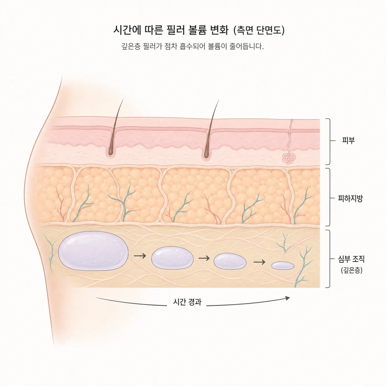 깊은 지방층에 채운 볼륨이 시간을 두고 옅어지는 모습