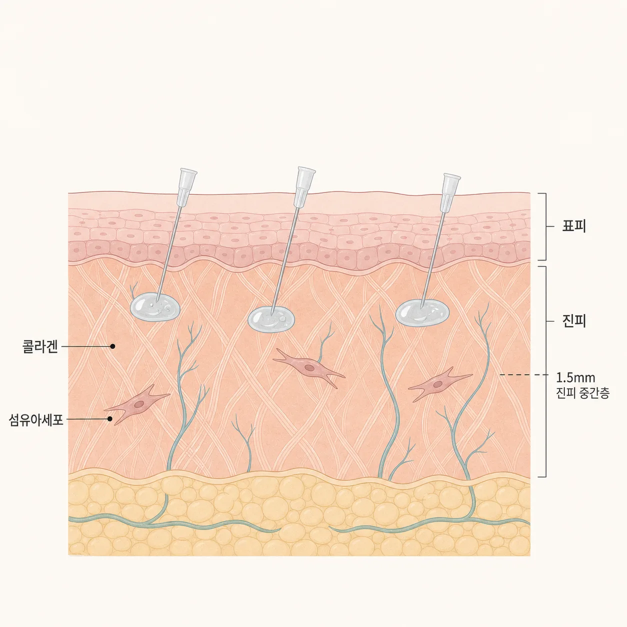 진피층과 콜라겐을 만드는 섬유아세포의 위치