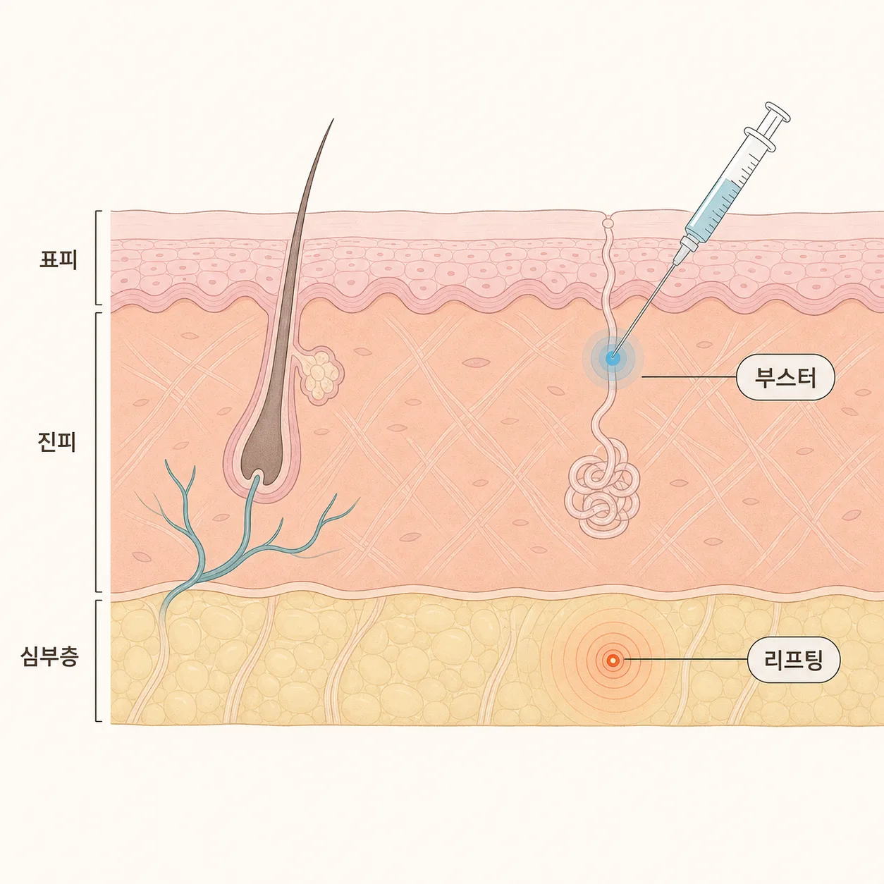 얕은 층에 작용하는 부스터와 깊은 층에 작용하는 리프팅