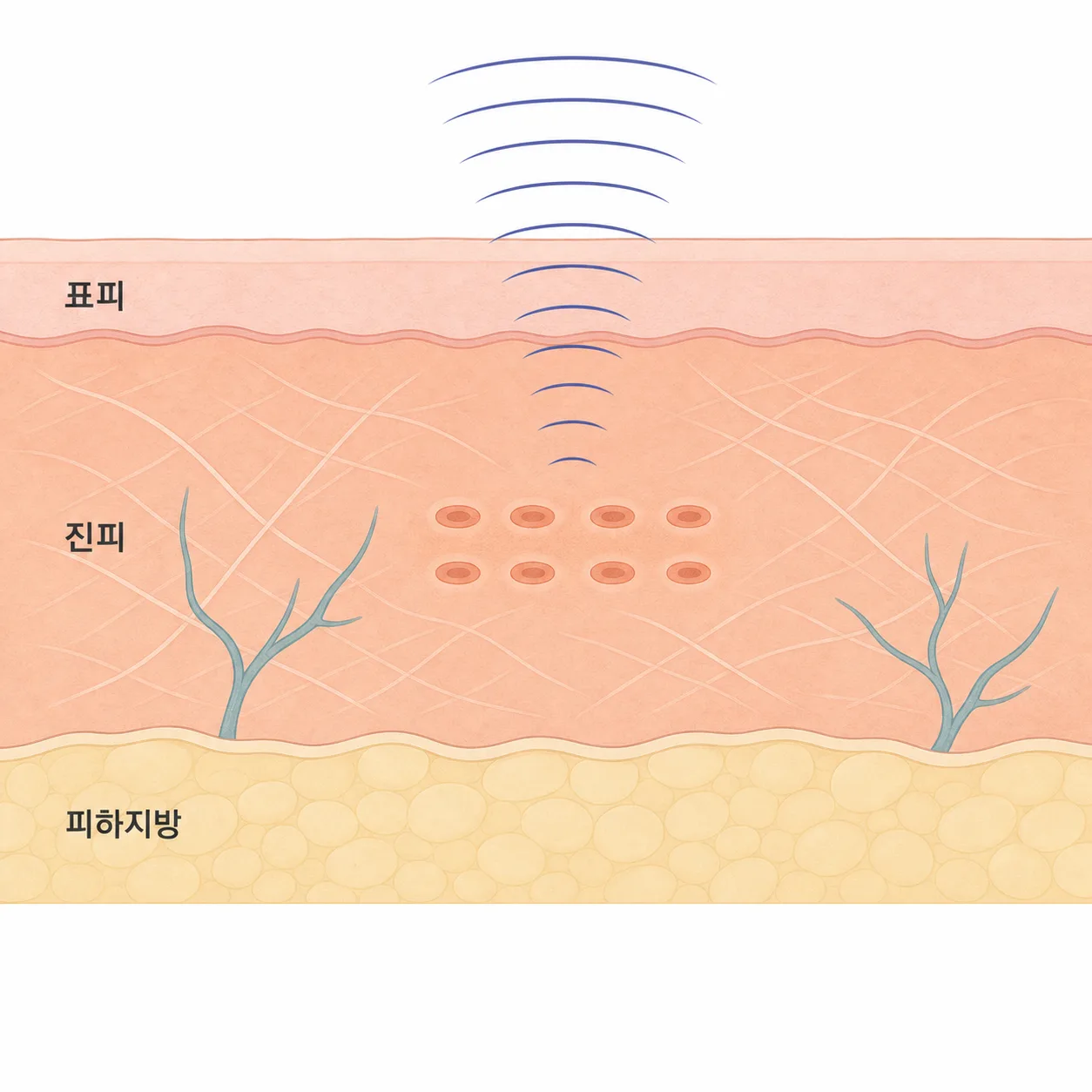시술 후 회복이 일어나는 피부층