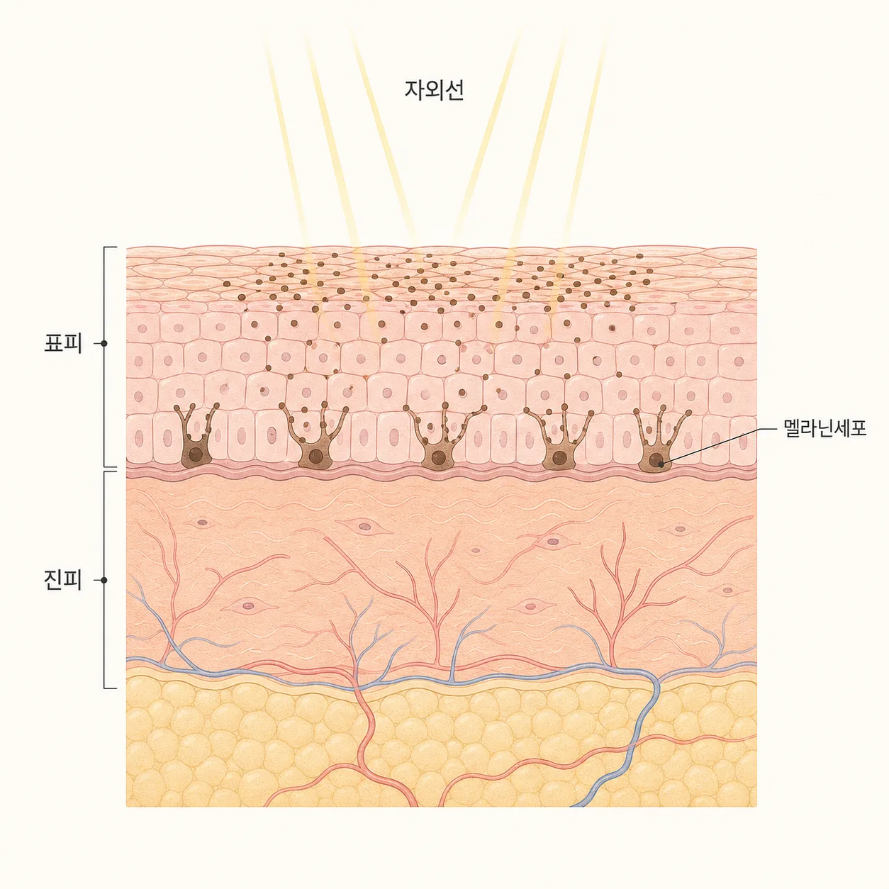 자외선이 약해진 피부 장벽을 자극해 멜라닌이 몰리는 모습