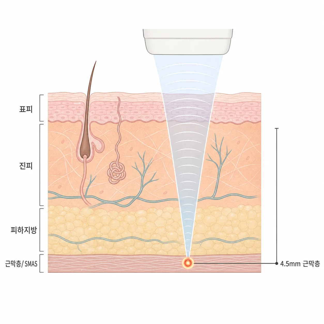 초음파 에너지가 근막층(SMAS)에 모여 열을 전달하는 깊이