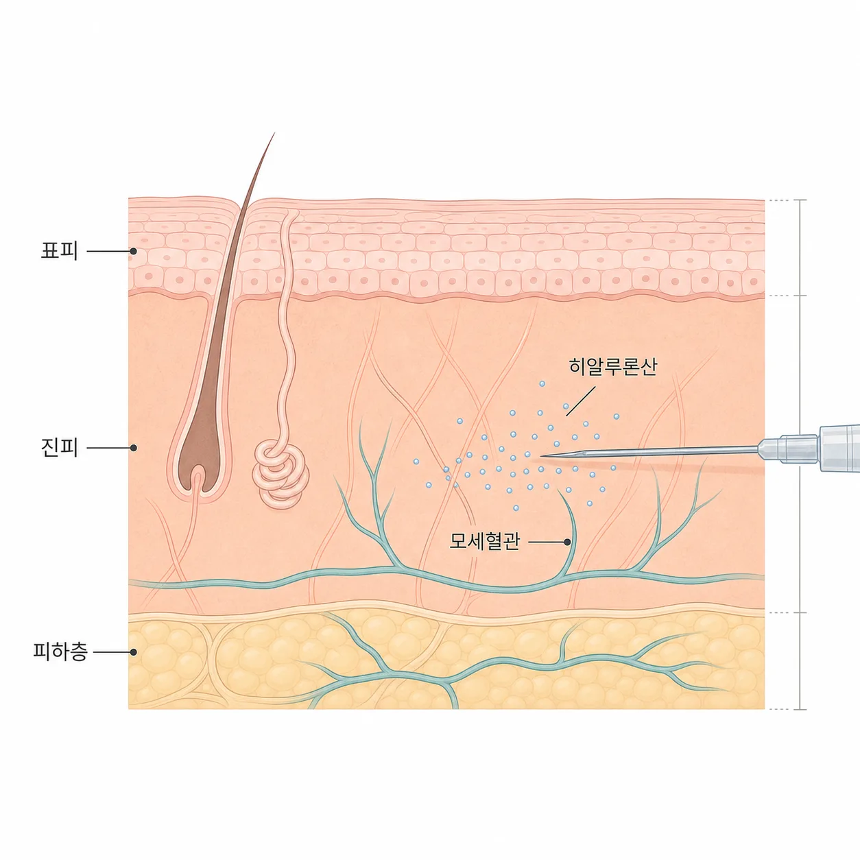 진피에 스킨부스터 성분이 주입되는 모습