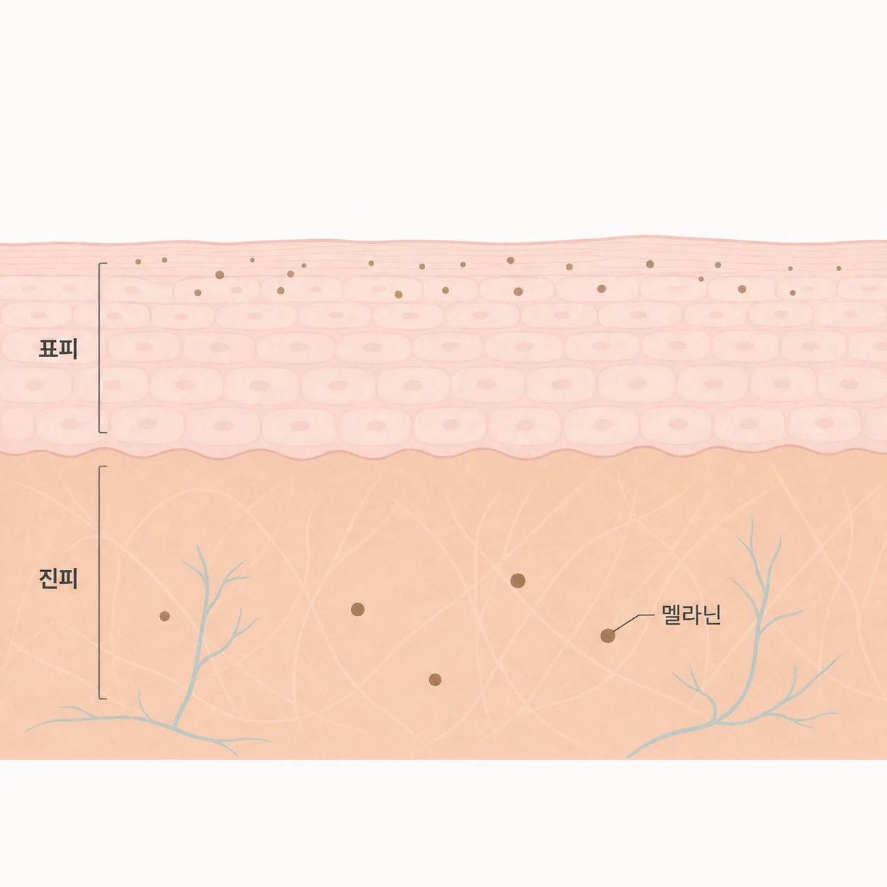 표피에 얕게 뜬 색소와 진피에 가라앉은 색소의 깊이 차이