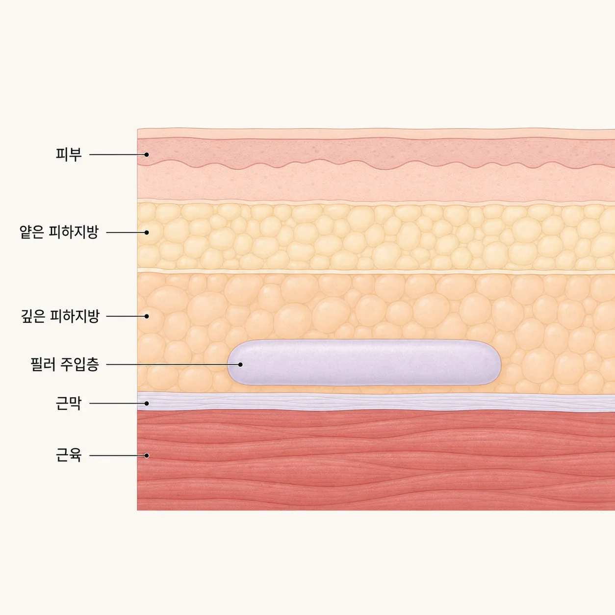 힙 조직의 층 구조와 근막 위 깊은 피하지방에 자리한 필러 주입층