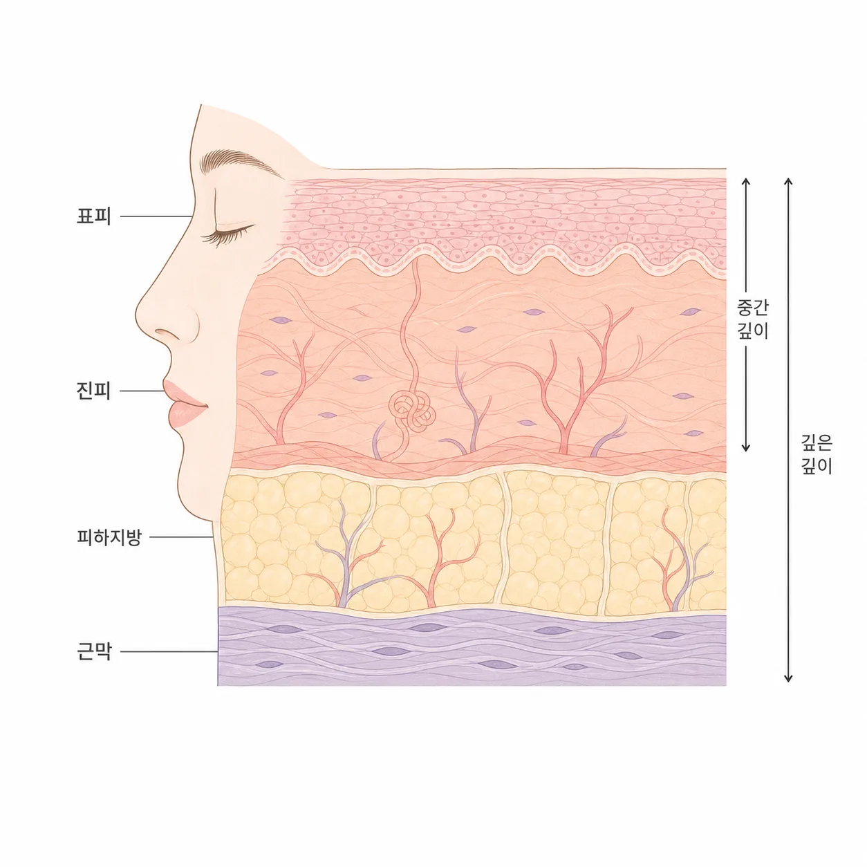 진피와 근막을 각각 겨냥하는 두 깊이 화살표