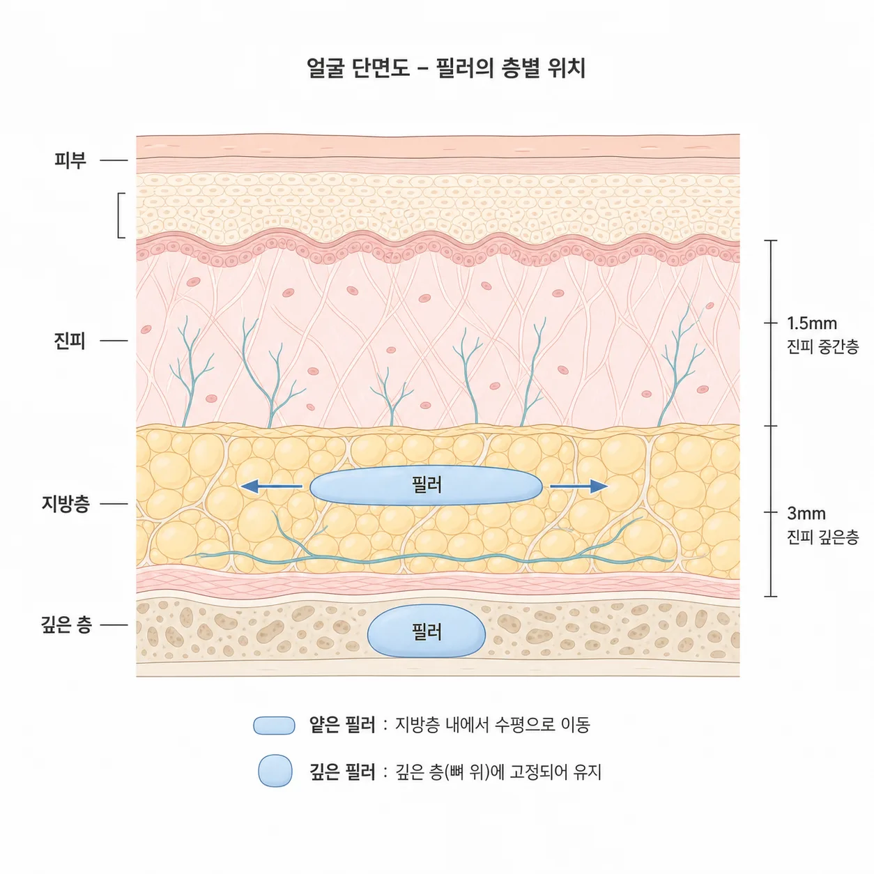 깊게 자리 잡은 필러와 얕은 층에서 조직면을 따라 밀리는 필러를 비교한 구조