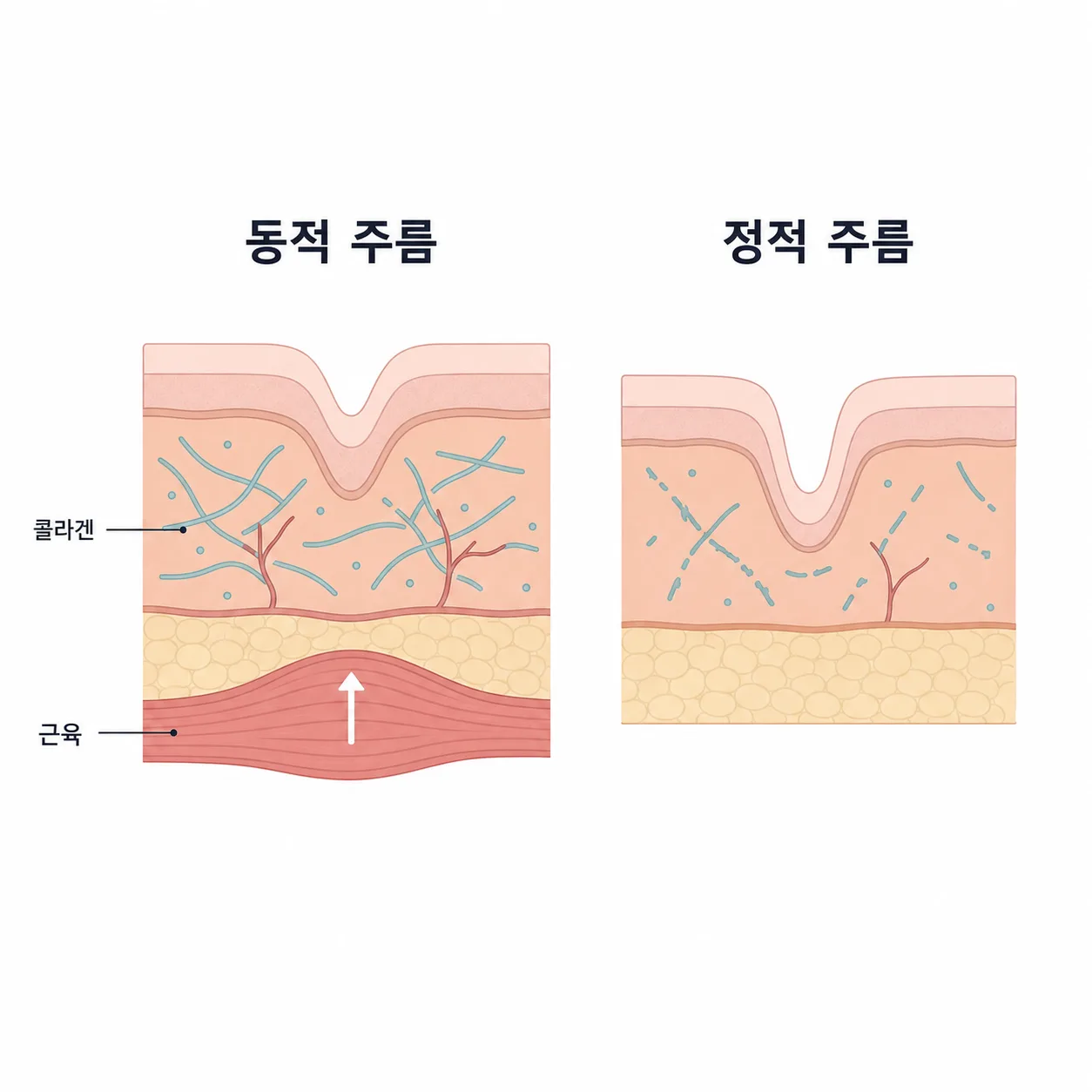 근육 수축으로 접히는 동적 주름과 피부 구조가 바뀌어 고정된 정적 주름의 비교