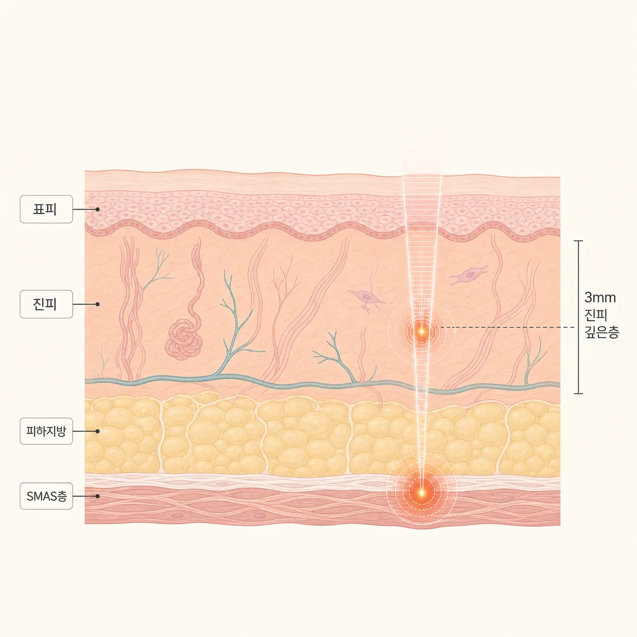 피부층별 열 전달 깊이 (표피·진피·SMAS층)