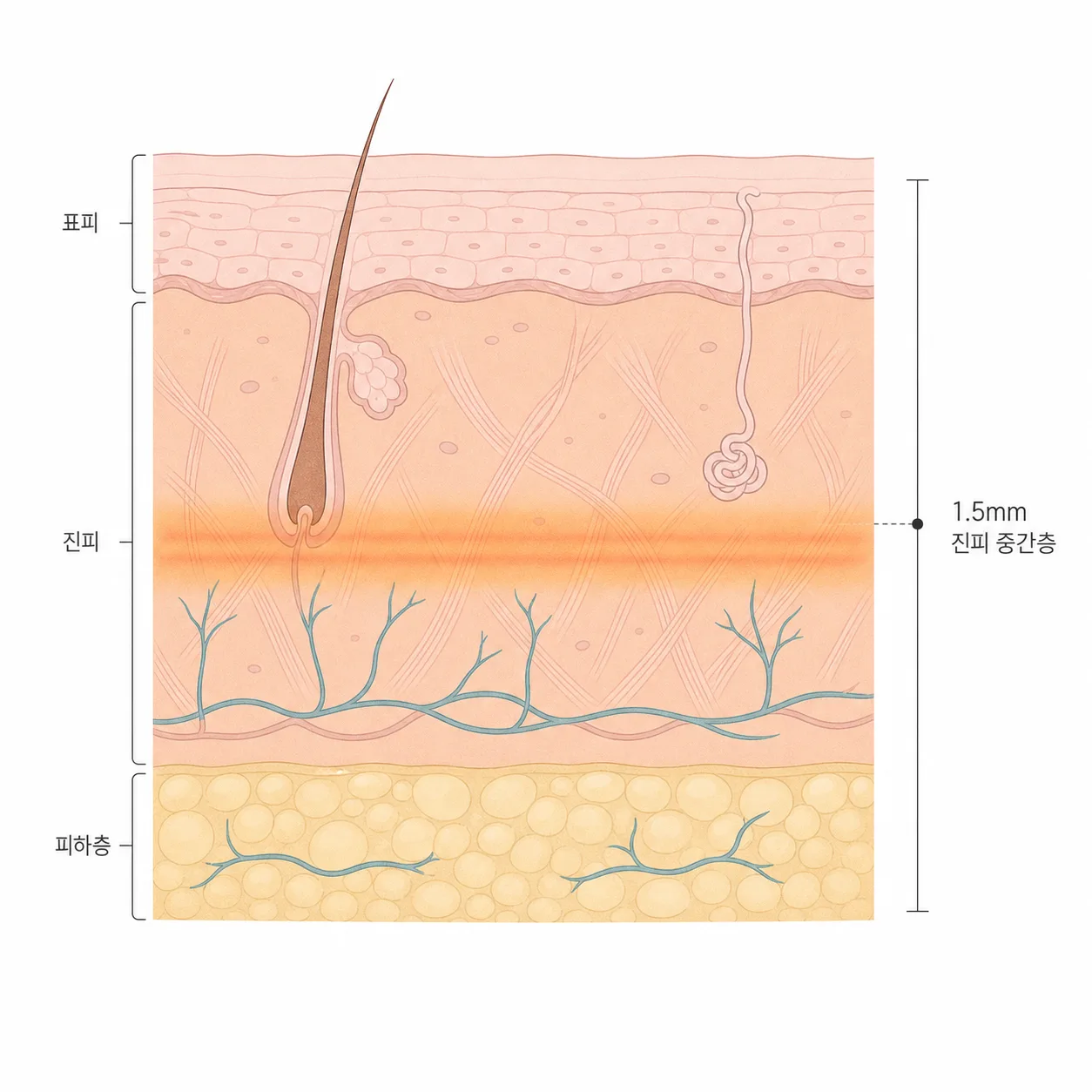 진피 중간층 약 1.5mm 깊이에 열이 전달되는 자리