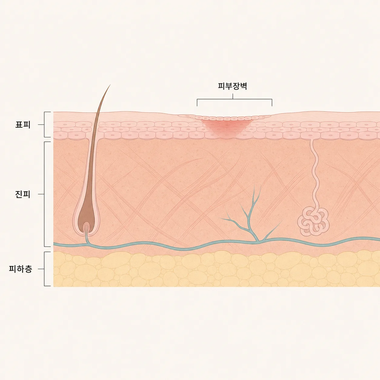 표피·진피·피하층과 회복 중인 피부 장벽