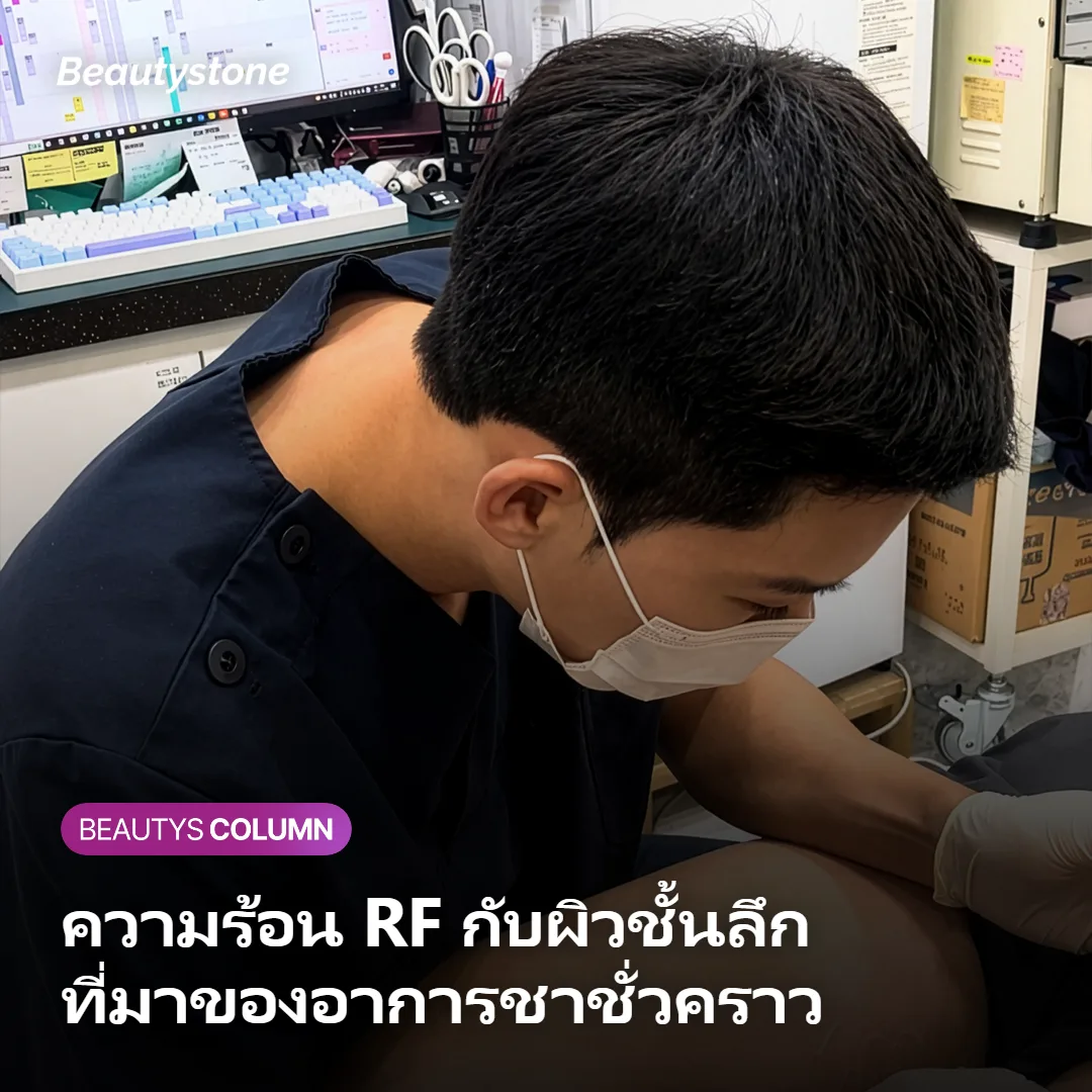 ภาพแสดงกลไกความร้อน RF ที่ส่งลงสู่ผิวชั้นลึกจนเกิดอาการชาชั่วคราว