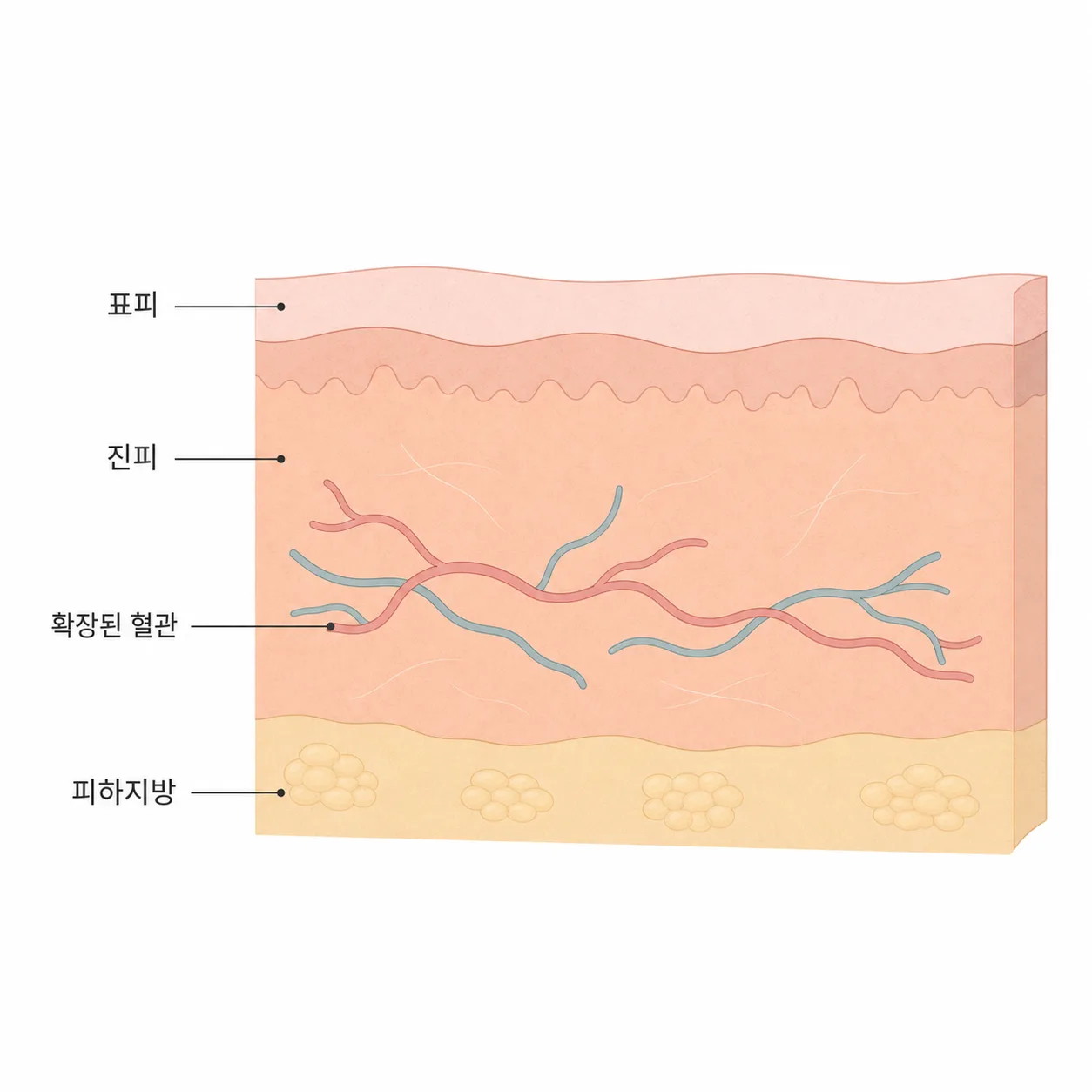 진피 속 확장된 혈관이 붉은기로 비쳐 보이는 피부 단면