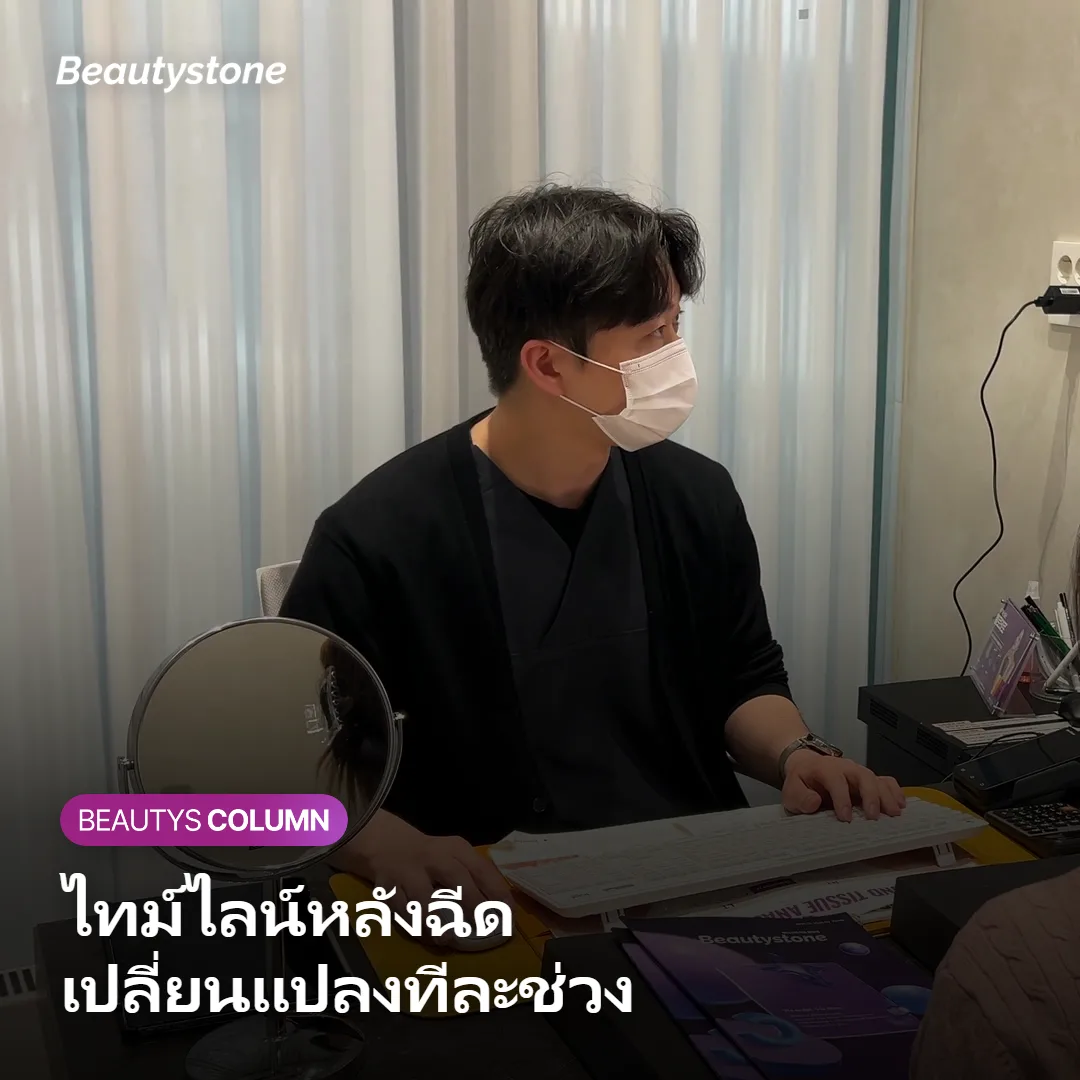 ภาพแสดงไทม์ไลน์การเปลี่ยนแปลงหลังฉีด Sculptra ในแต่ละช่วง