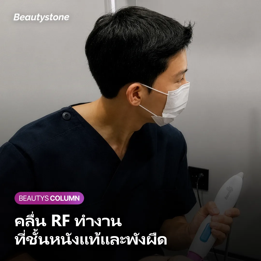 ภาพแสดงชั้นผิวที่คลื่น RF ทำงานคือชั้นหนังแท้และชั้นพังผืด
