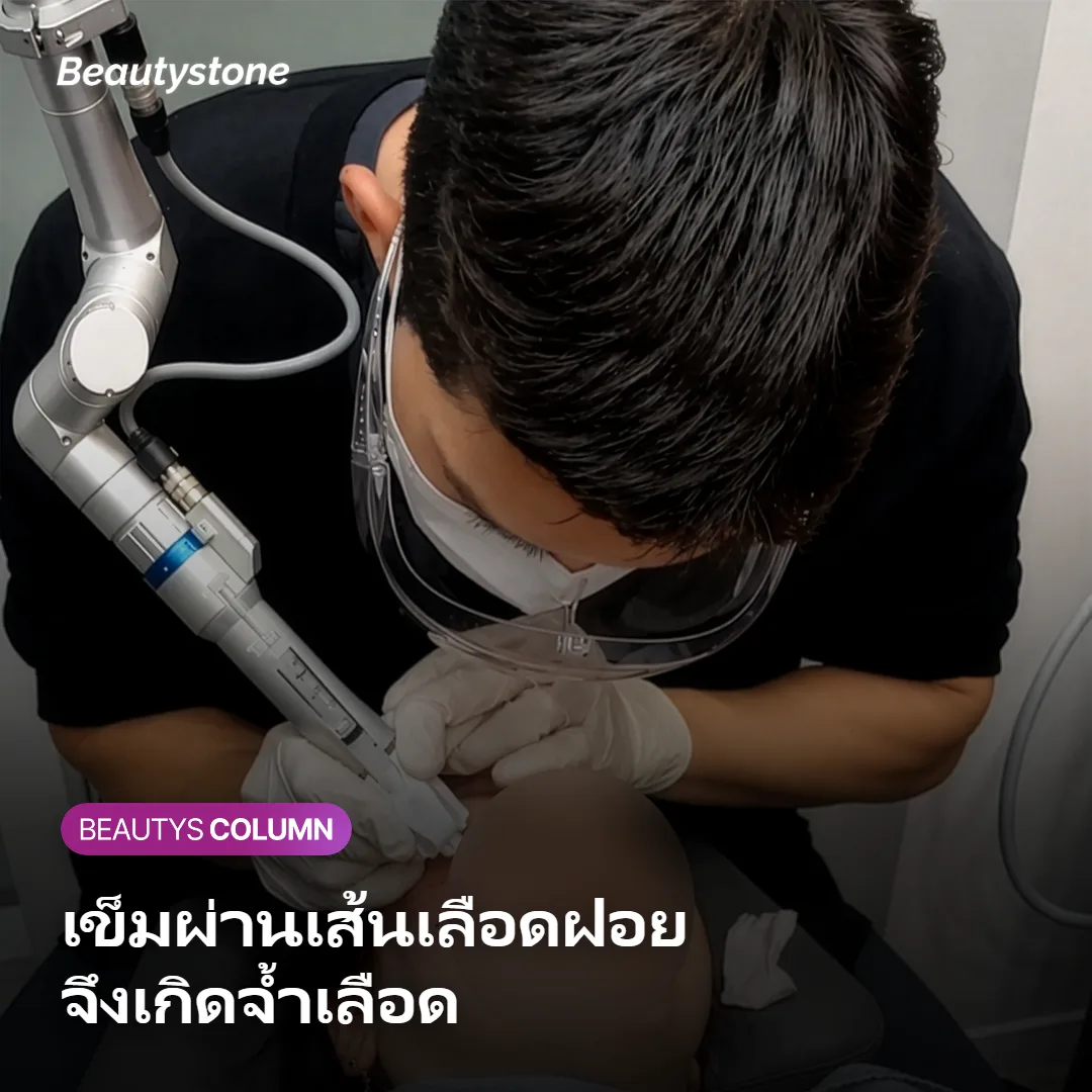 ภาพแสดงเข็มฉีดผ่านชั้นผิวลึกและสัมผัสเส้นเลือดฝอยจนเกิดจ้ำเลือด