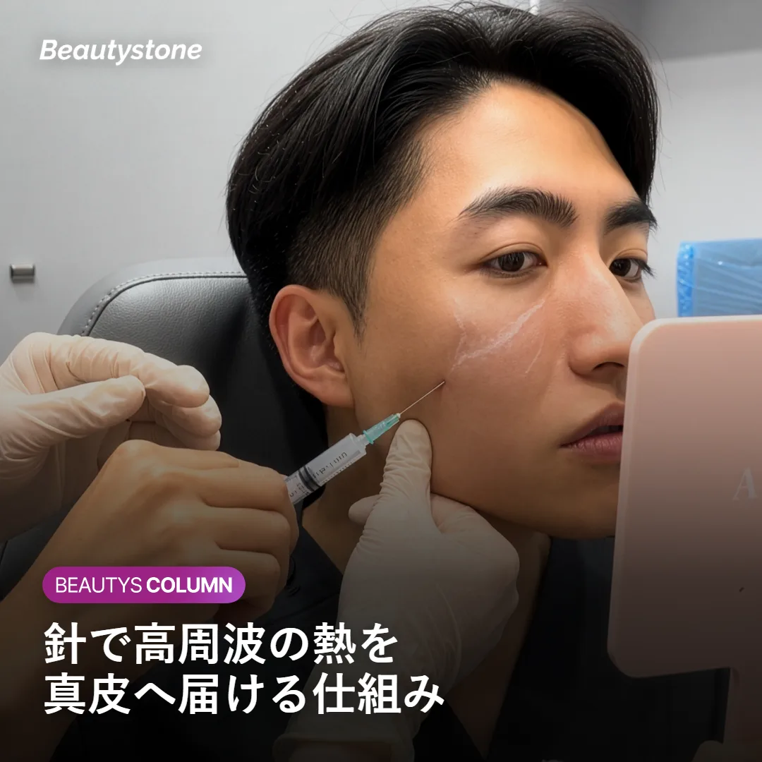 細い針が高周波の熱を真皮へ届けるポテンツァの仕組みを示す図