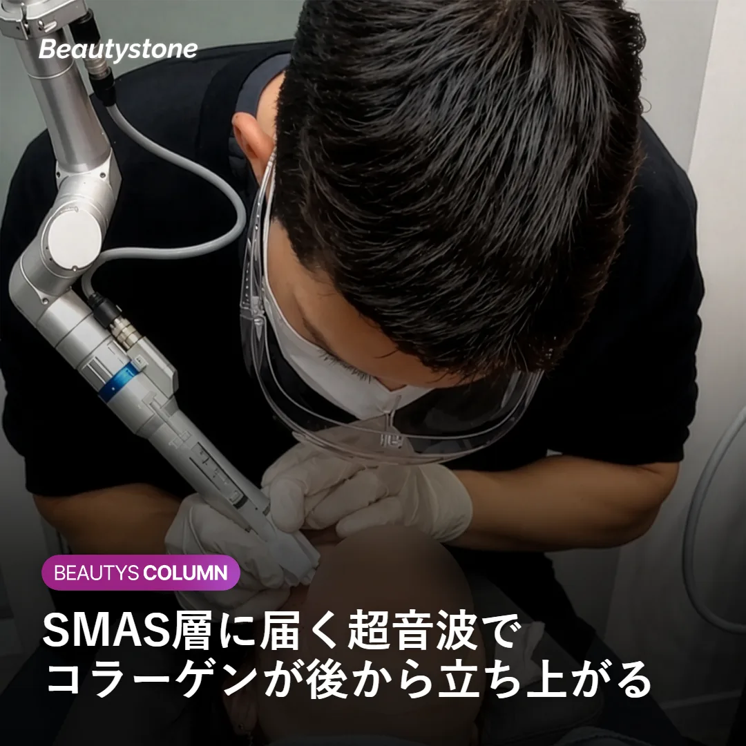 表皮・真皮の下のSMAS層の深さに超音波の焦点が集まる仕組みを示す図