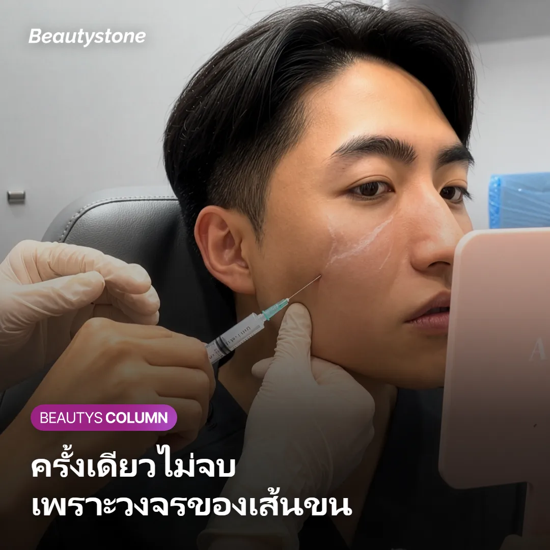 ภาพแสดงกลไกที่เลเซอร์ทำงานกับรากขนในระยะเจริญเติบโตตามวงจรของเส้นขน