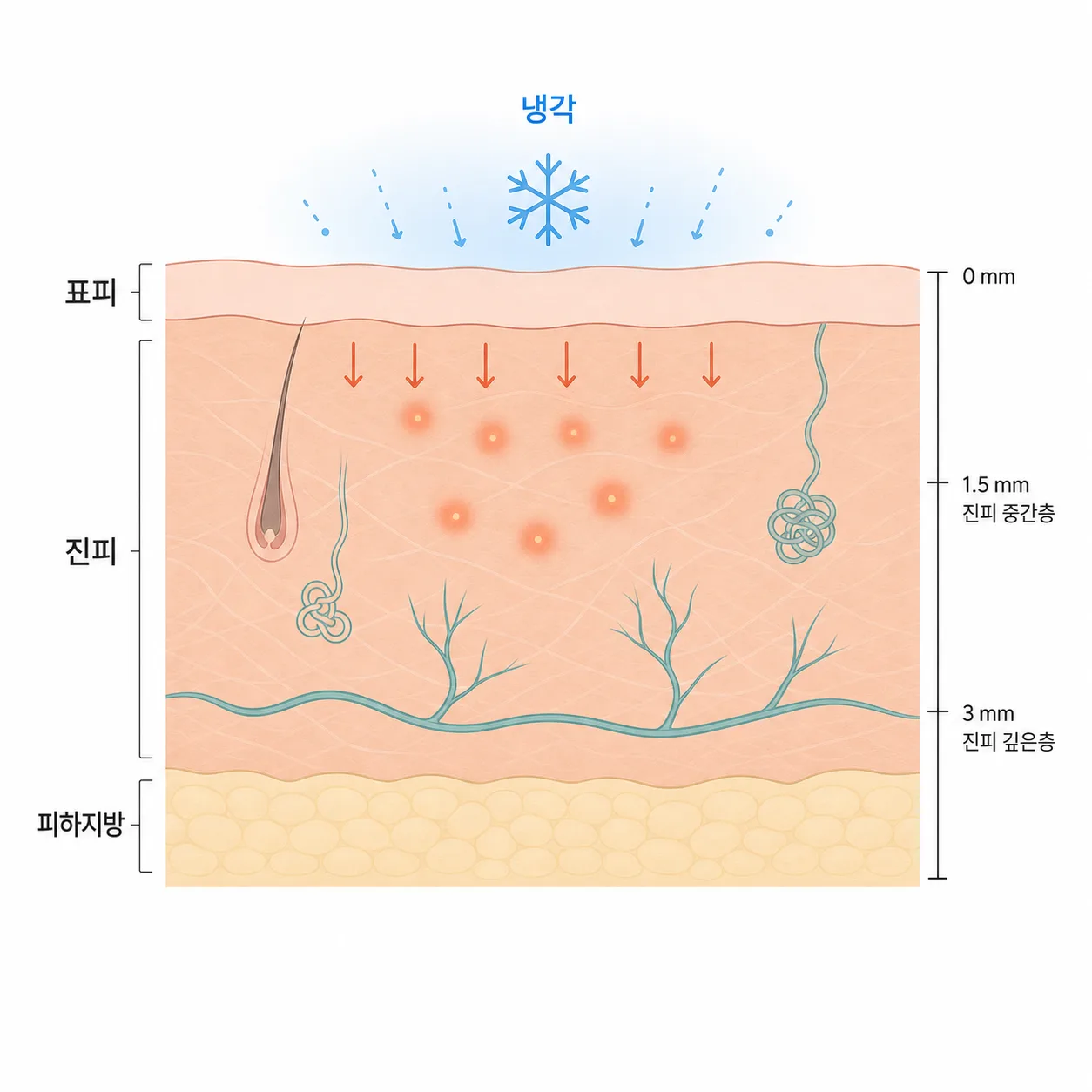 표면은 식히고 진피에 전달되는 고주파 열