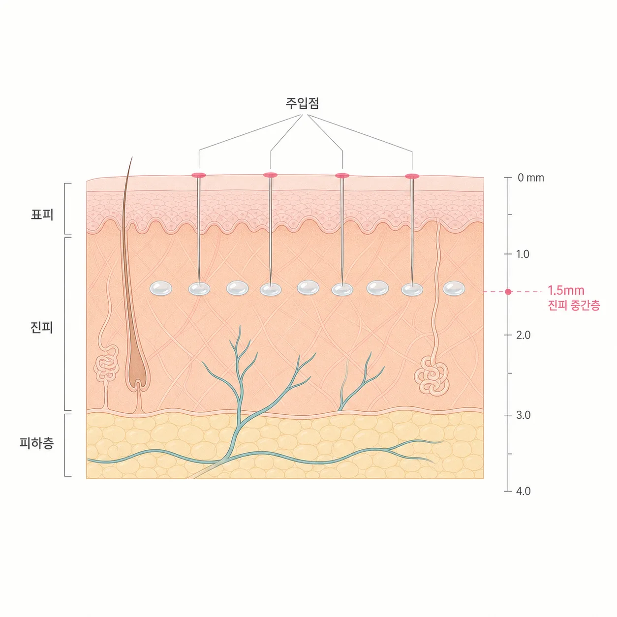 진피에 얕게 나눠 주입되는 스킨부스터