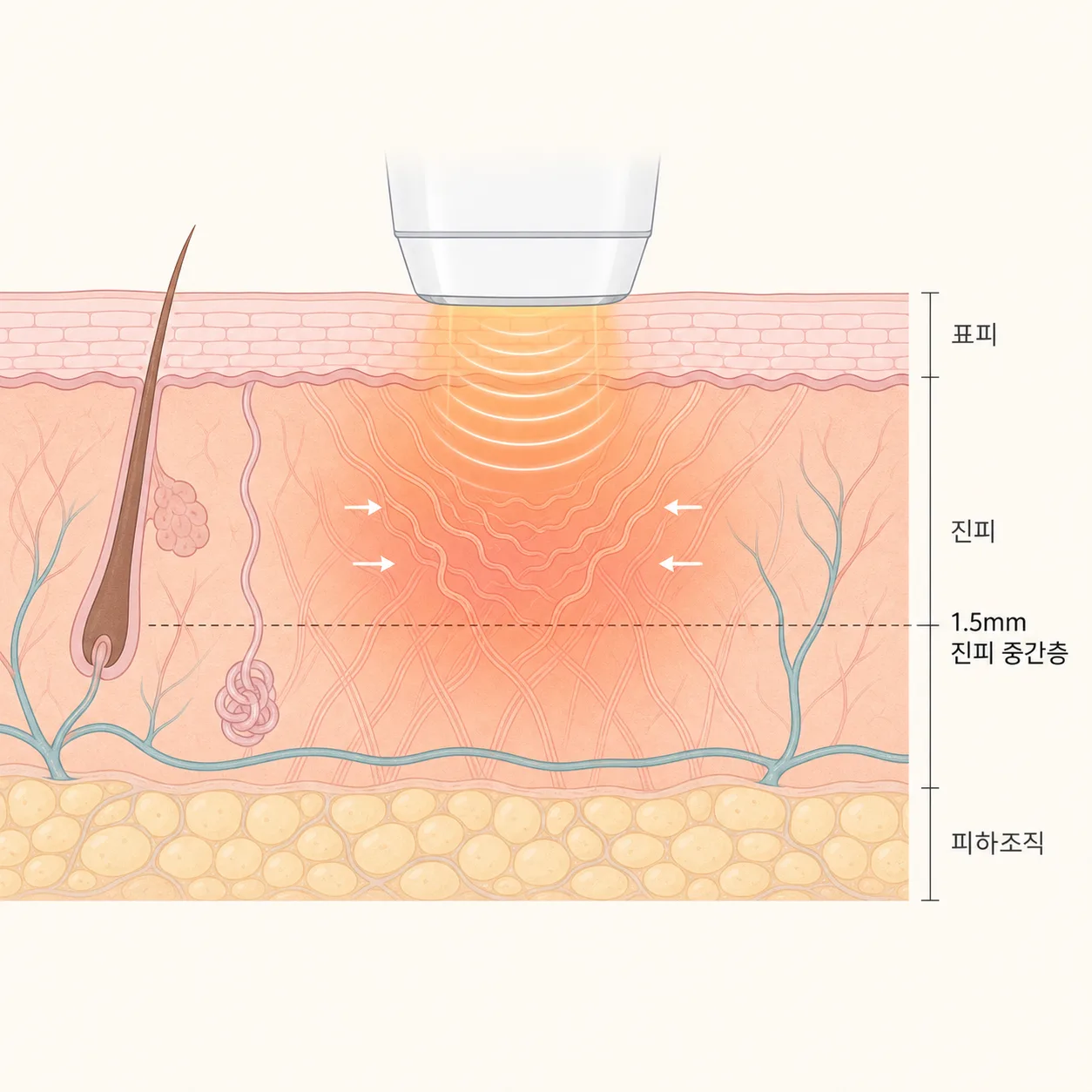 인모드 FX는 표피를 건드리지 않고 진피층에 열을 전달해 콜라겐을 자극해요.