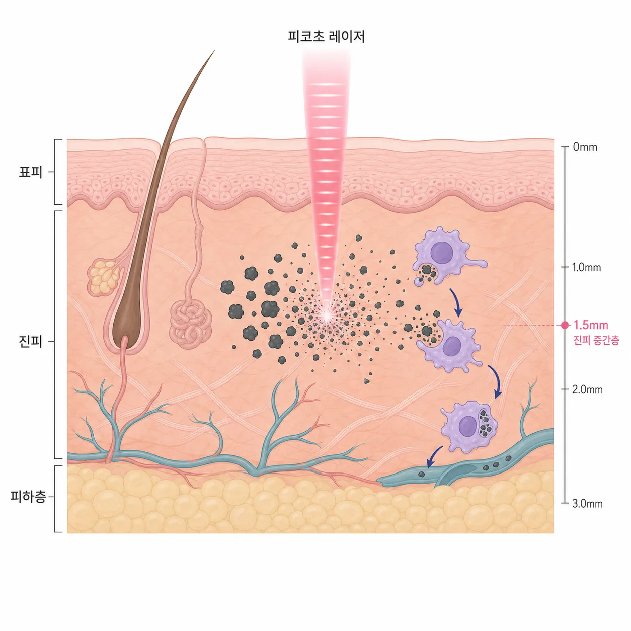 피코웨이는 잉크를 잘게 부수고, 면역세포가 파편을 조금씩 밖으로 내보내며 문신이 옅어져요.