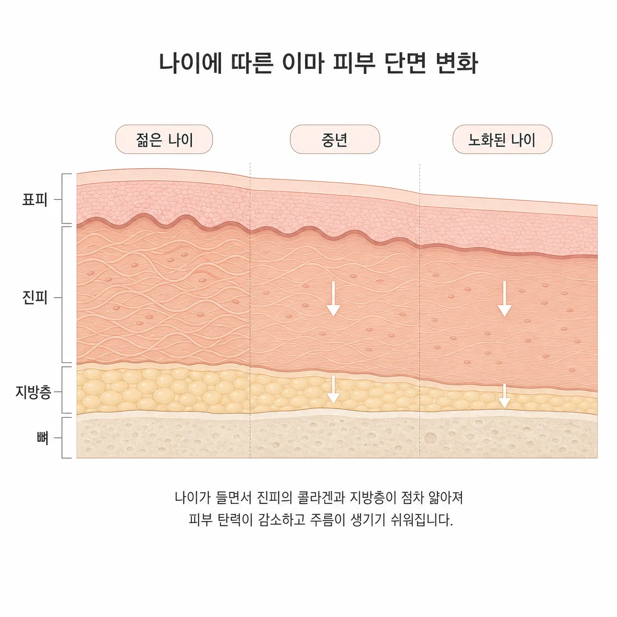 나이가 들며 얇아지는 이마의 지방층과 콜라겐