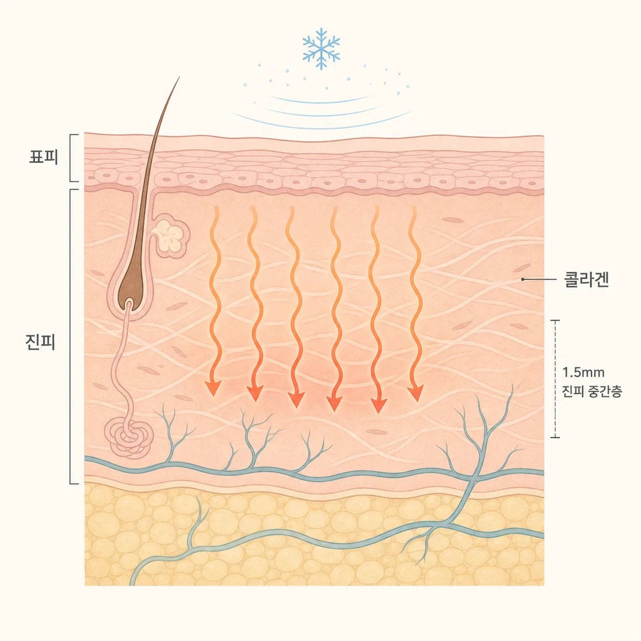 표면은 식히고 진피에 열을 전하는 마이크로웨이브의 원리