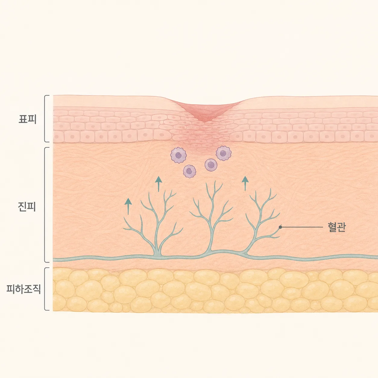 회복기에 새 혈관이 자라며 상처가 아무는 과정