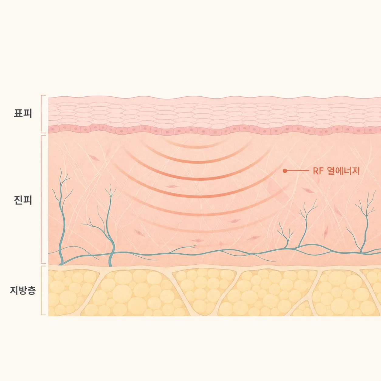표면은 식히고 진피에 열을 전달하는 온다리프팅 원리
