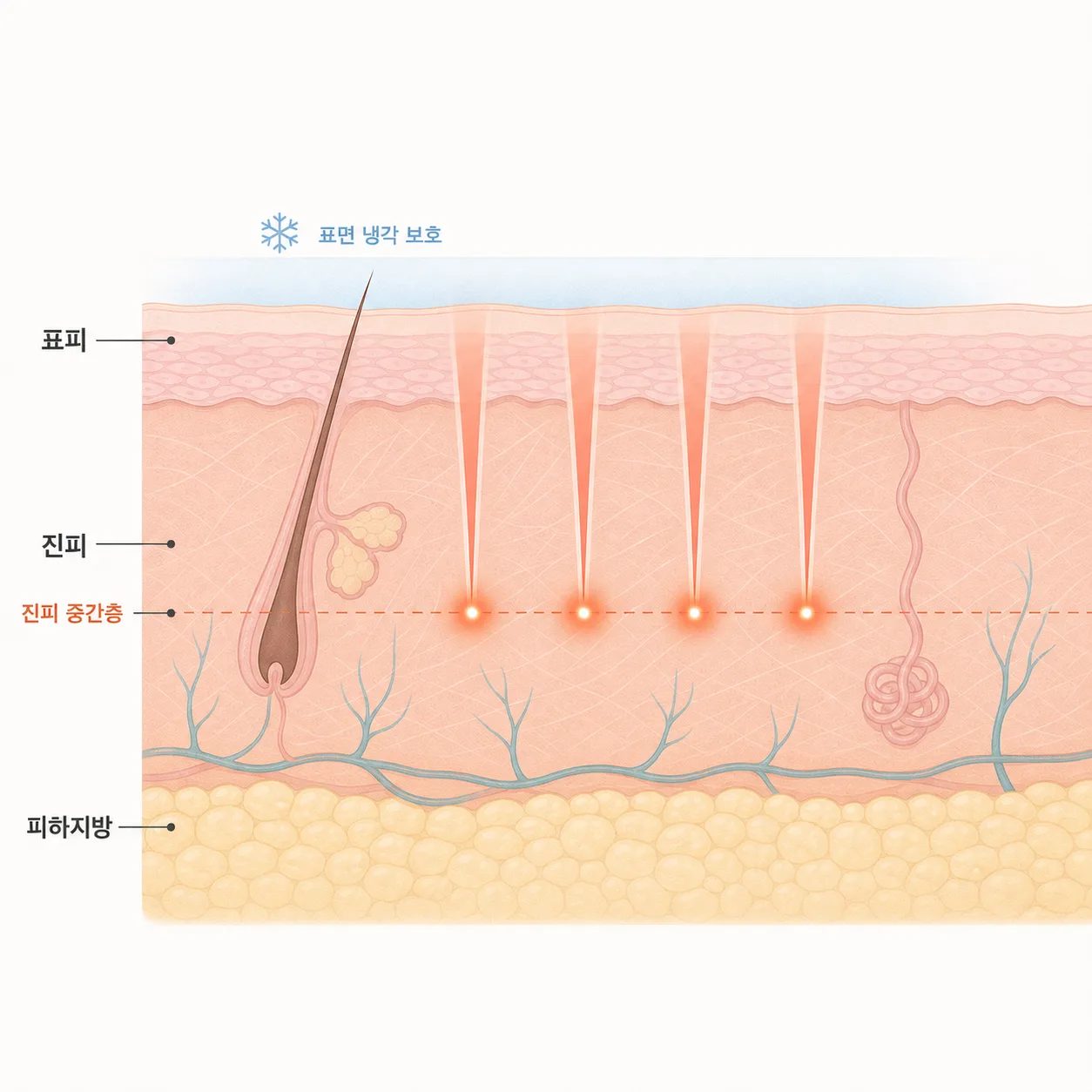 표피는 냉각으로 보호하고 진피 중간층에 열을 모으는 구조