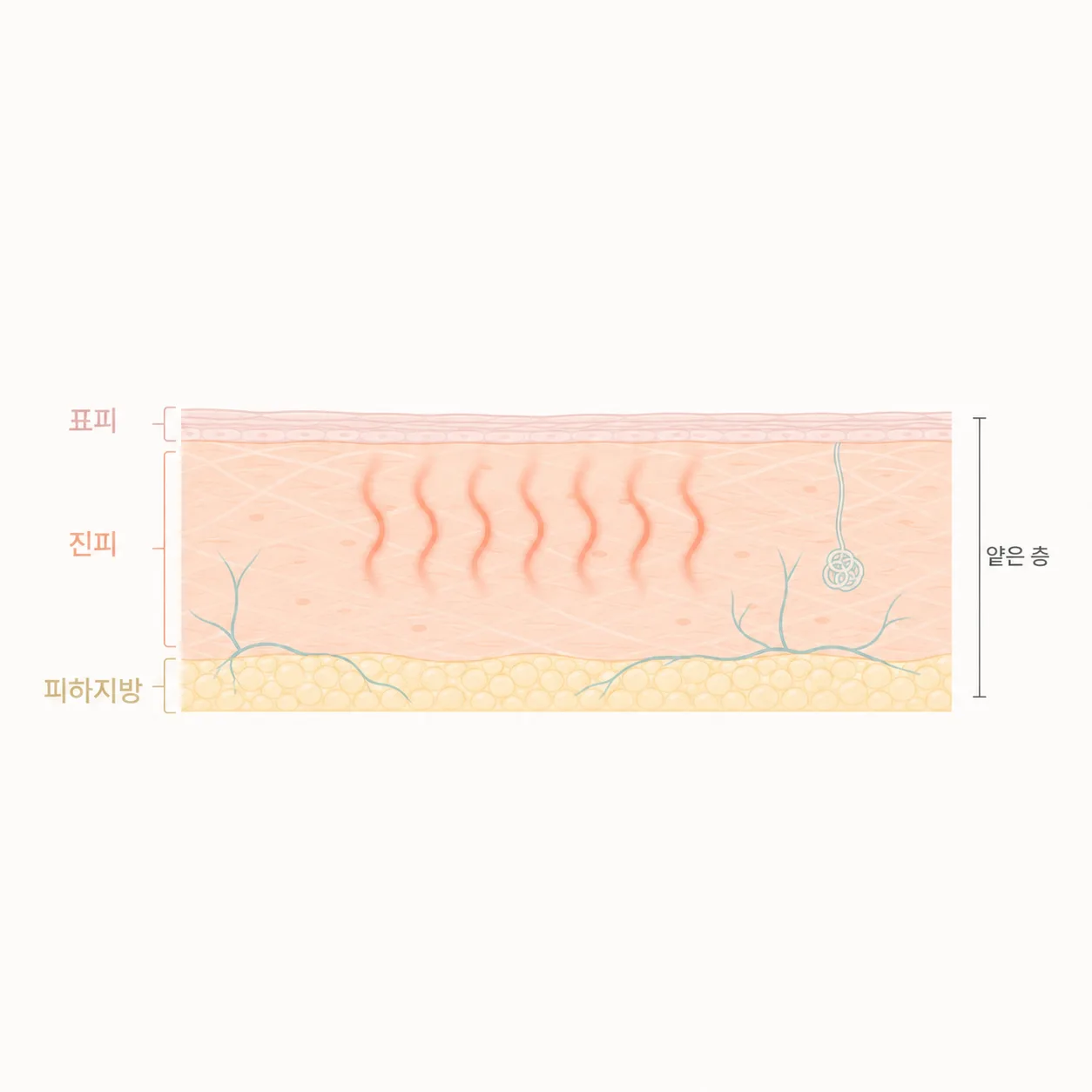 얇은 눈가 피부에서 표면은 냉각하고 진피에 열을 모으는 구조