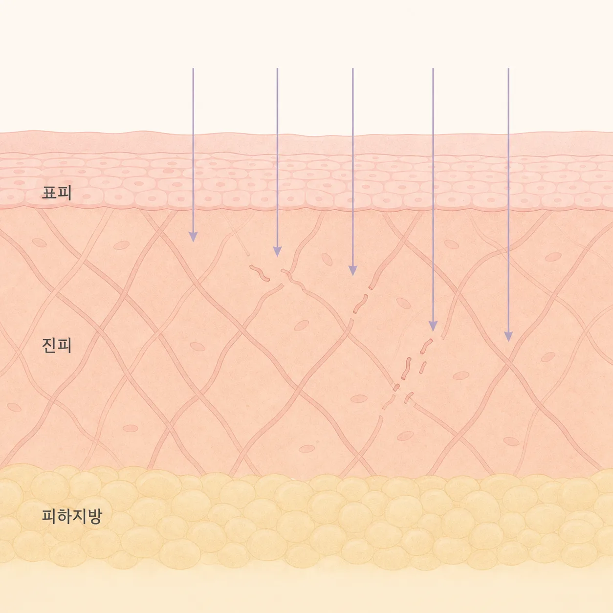 자외선이 진피에 닿아 콜라겐 그물이 끊어지는 구조
