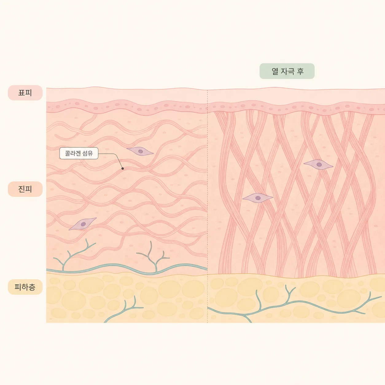 열 자극 이후 콜라겐이 재배열되는 과정을 단순화한 그림이에요.