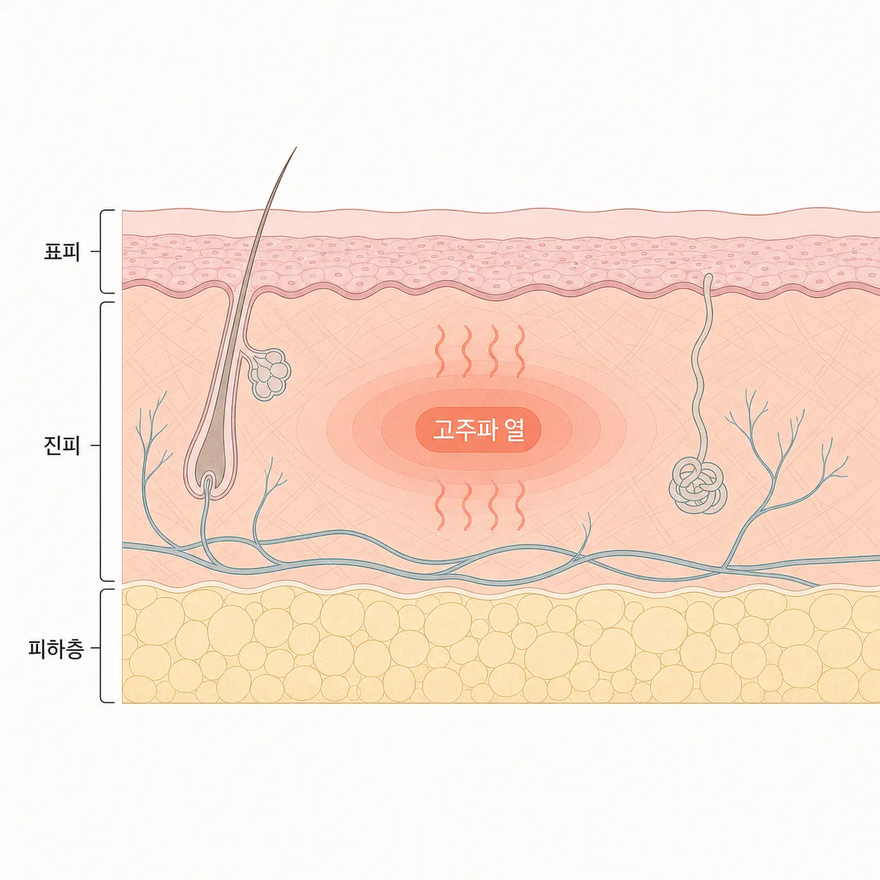 써마지의 열이 주로 진피에 작용하는 모습을 단순화한 그림이에요.