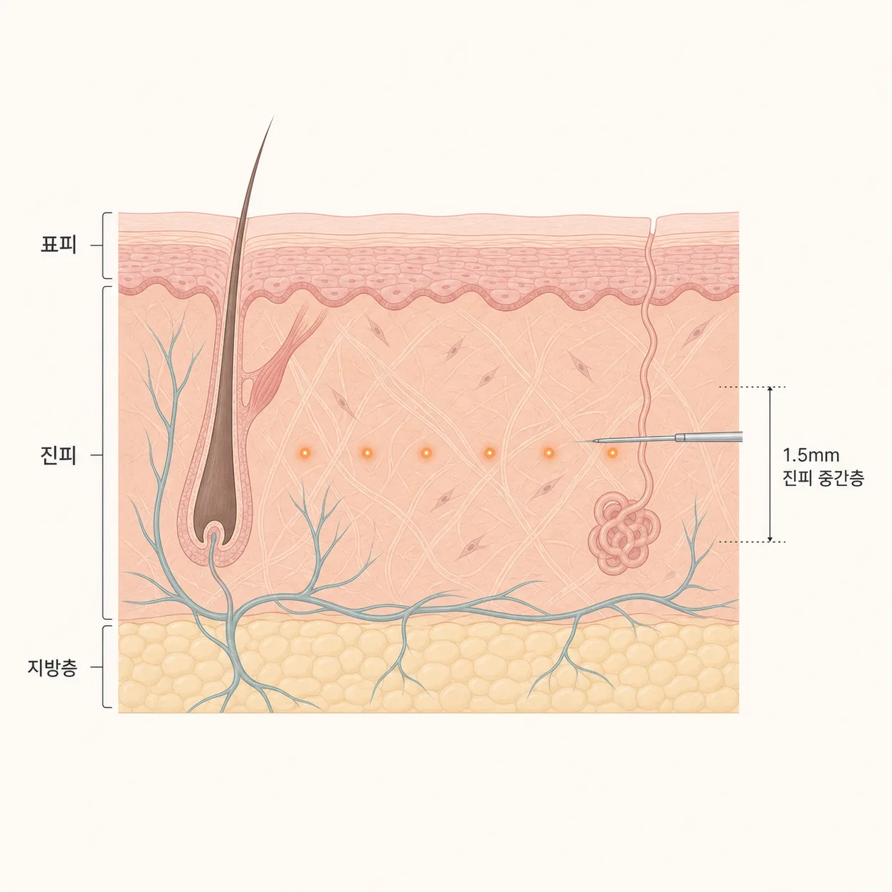 소프웨이브는 진피 중간층, 지방 관리 시술은 그 아래 지방층을 겨냥해요