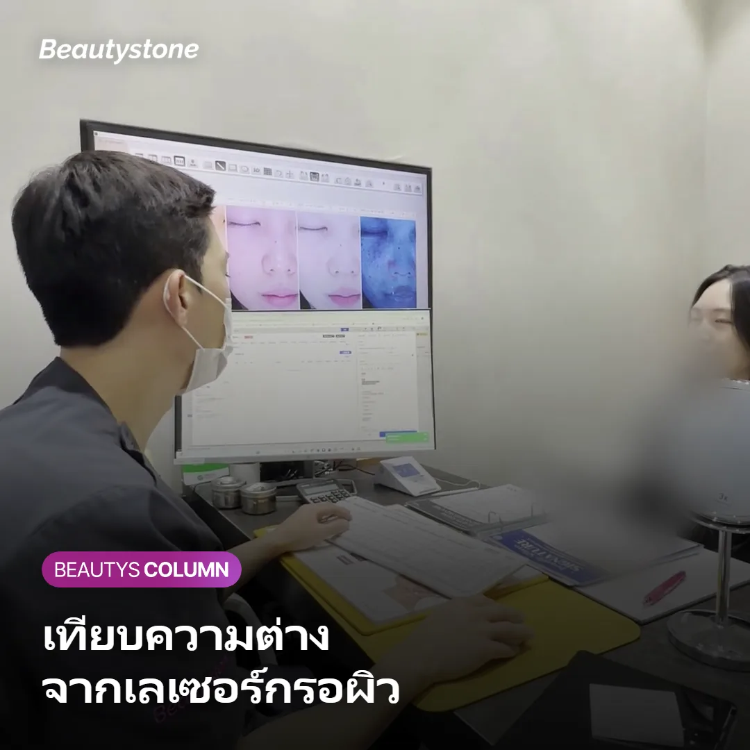 ภาพเปรียบเทียบ Secret RF กับเลเซอร์กรอผิว