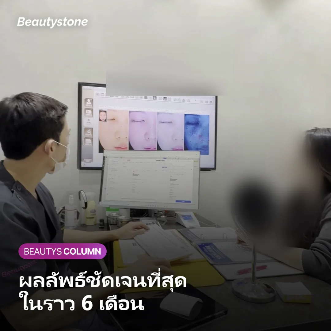 ภาพแสดงไทม์ไลน์ผลลัพธ์ Thermage รอบดวงตาตั้งแต่หลังทำถึง 6 เดือน