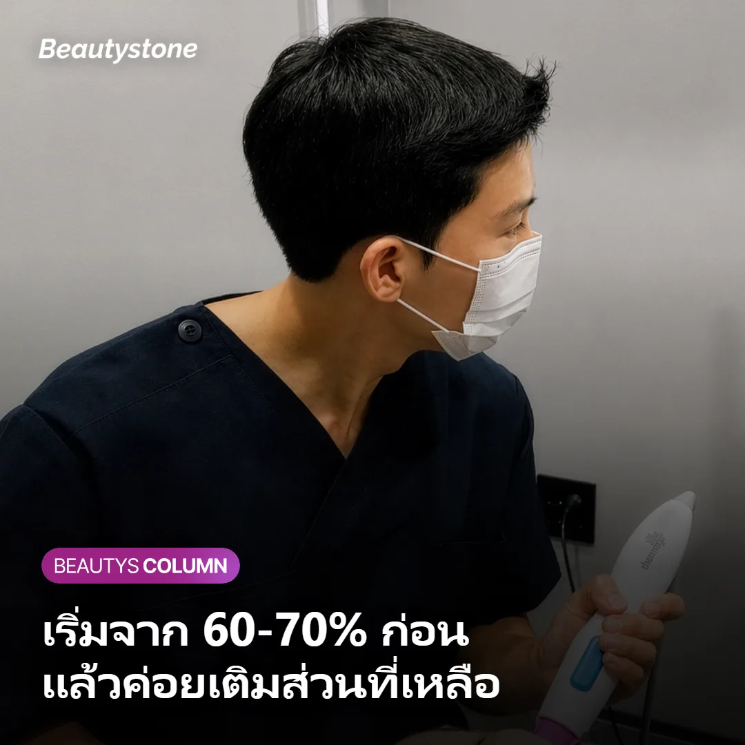 ภาพแสดงขั้นตอนการแบ่งฉีดฮิปดิพฟิลเลอร์หลายครั้งเพื่อผลลัพธ์เป็นธรรมชาติ