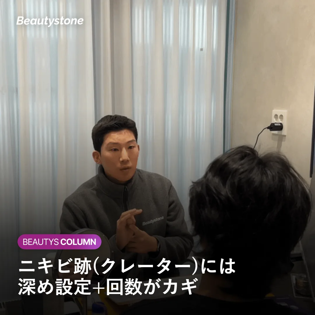 ニキビ跡（クレーター）への深め設定シークレットRFを示す図