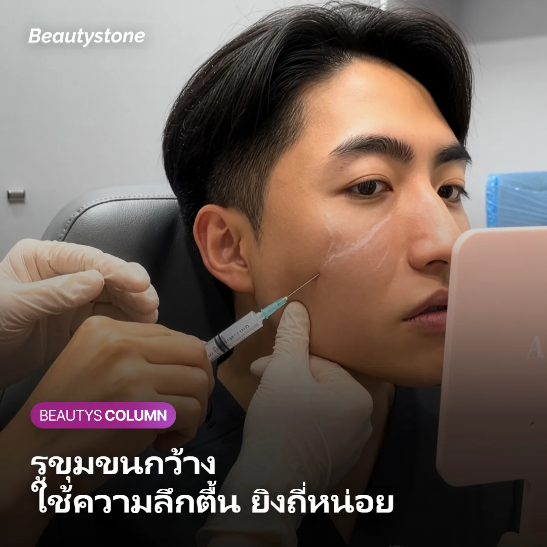 ภาพแสดงการตั้งความลึกตื้นของ Secret RF สำหรับรูขุมขน