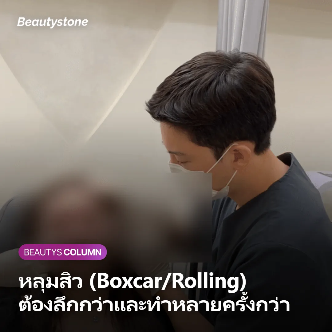 ภาพแสดงการตั้งความลึกมากของ Secret RF สำหรับหลุมสิว