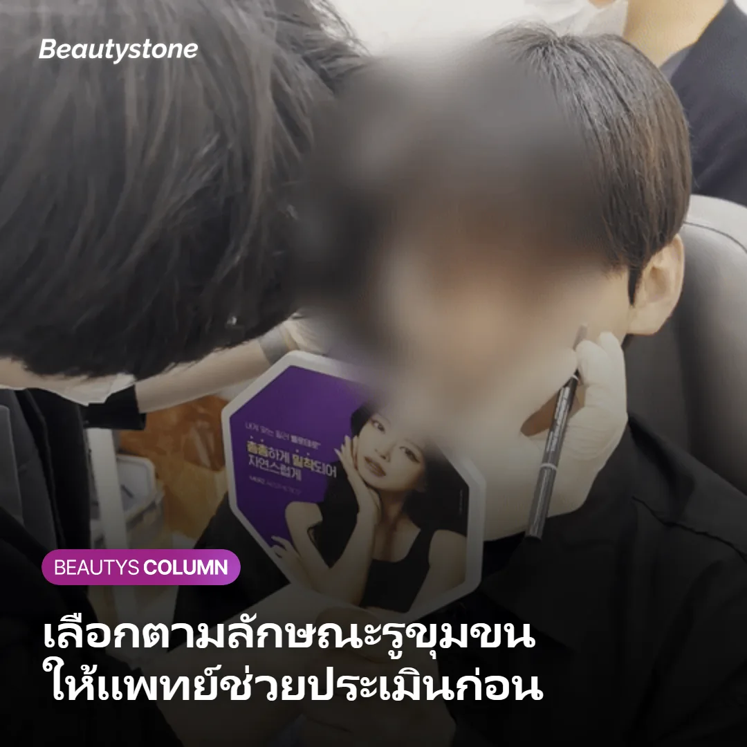 ภาพแสดงแนวทางเลือก InMode หรือ Potenza ตามลักษณะรูขุมขน