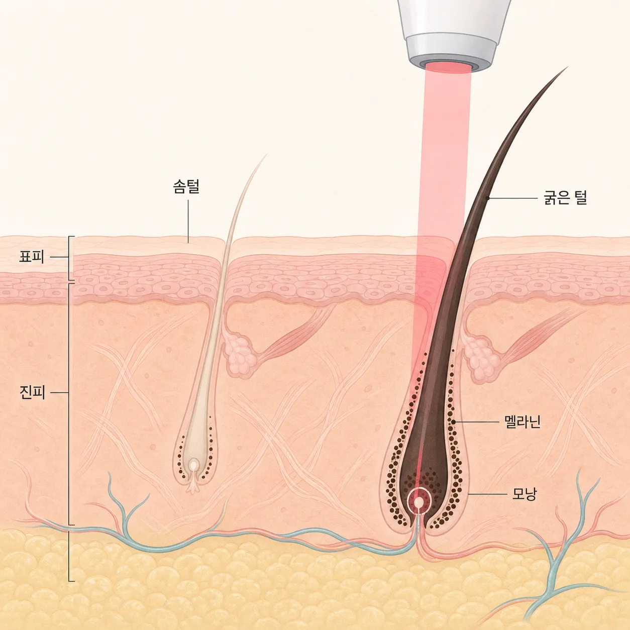 솜털은 멜라닌이 적어 굵은 털보다 레이저 반응이 약해요